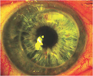 Figure 2. The patient immediately after lens removal.