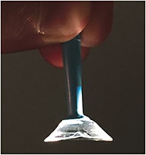 Figure 6. Elevation-specific scleral lens derived from a 3D-scanned ocular impression. Note the irregular shape of the lens haptic, which is highly asymmetric, with an edge elevation to overcome a large pinguecula.