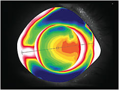 Figure 1. Profilometry of the eye showing a high level of conjunctival toricity and the presence of a significant nasal elevation. Photo courtesy of Aaron Wolf, OD