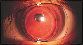 Figure 2. Inferior-temporal decentration of lens showing no movement of hybrid lens on eye at the one-week follow-up visit (soft skirt outline = purple, GP outline = green). The patient was very happy with the comfort of this lens on eye.