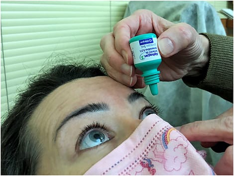 Figure 3. The practitioner instilled the drug over the scleral lens.