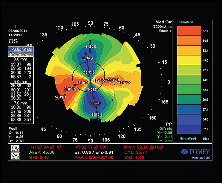 Figure 3. Patient #1’s graft just over a year after the Figure 2 image now shows nearly 26.00D of graft astigmatism on anterior surface topography.