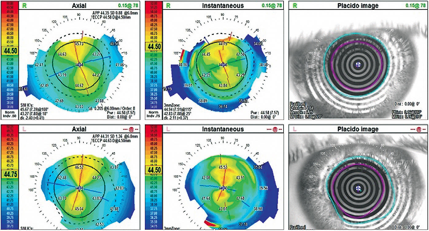 Figure 1. This patient’s larger-than-normal HVIDs required custom soft lenses with larger diameters to improve comfort as well as the stability and quality of the visual acuity.