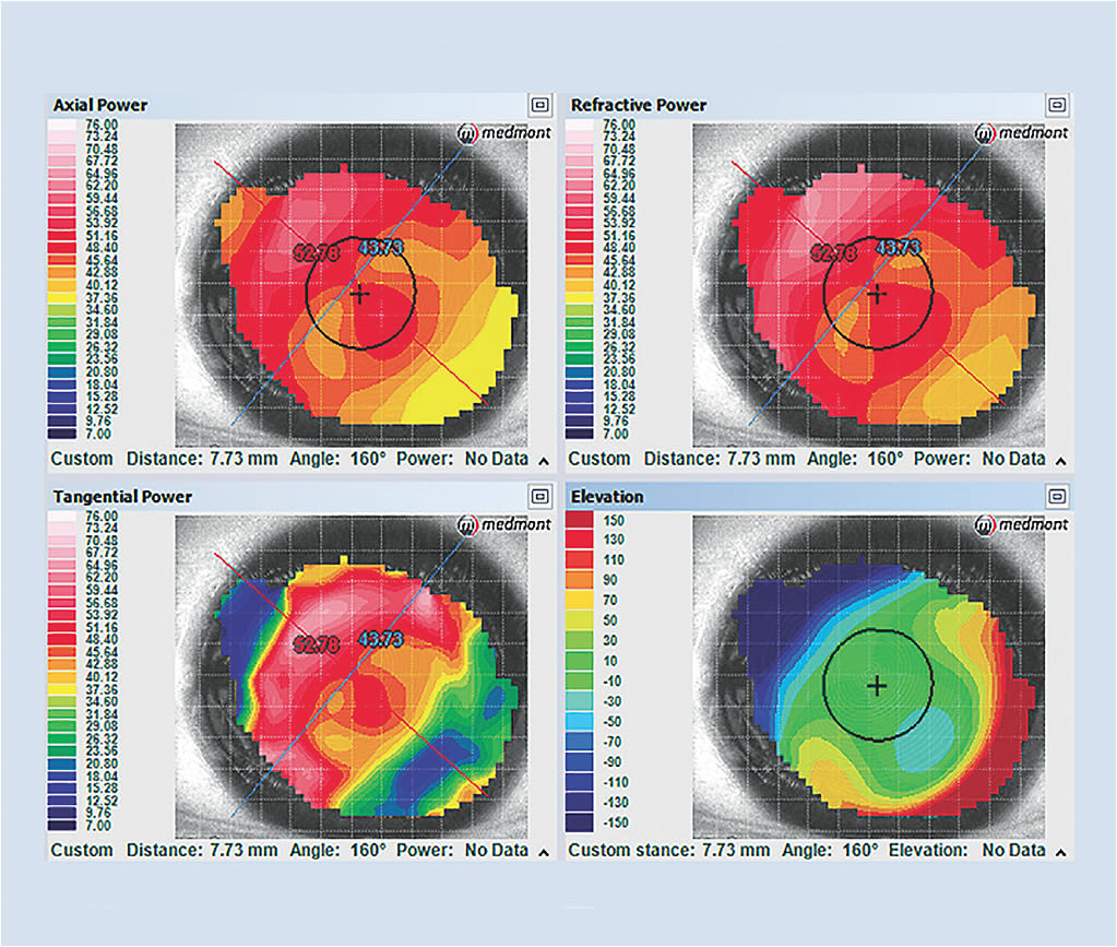 Figure 1. Should this post-graft cornea be fit with a corneal or a scleral lens?