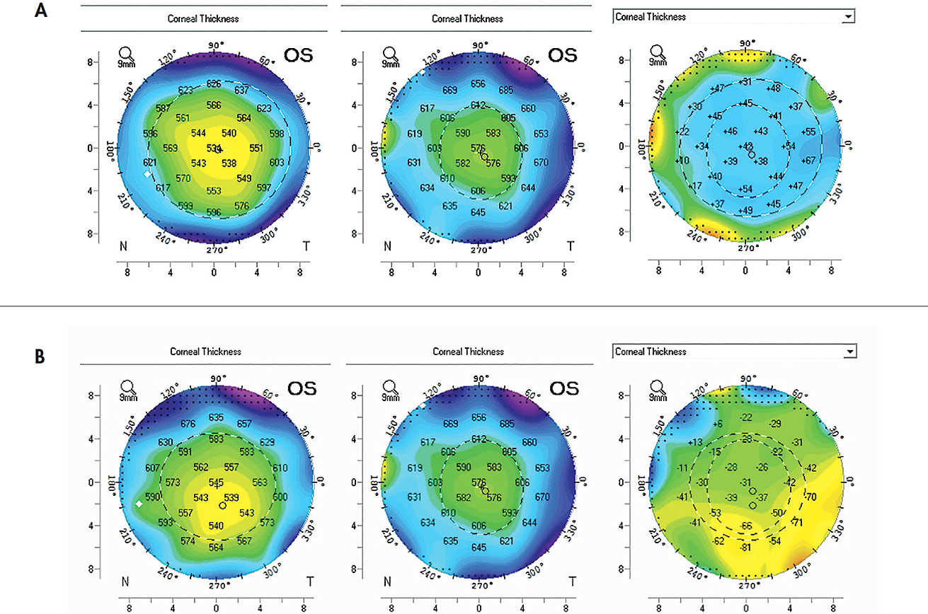 Figure 13. Scheimpflug camera-based optical pachymetry, difference maps. This case shows the effect of scleral lens wear on a three-year-old full-thickness corneal transplant. The patient had failed other contact lens modalities due to an elevated graft-host junction. (A) Baseline pre-lens-wear thickness map (left); one year of scleral lens wear post-lens-wear thickness map wearing a 0.42mm center thickness lens, 100 Dk material, 200 microns of apical clearance, minimal tear exchange, average daily lens wear of 14 hours (center); and a difference map showing global increase in corneal thickness (right). The cornea showed no sign of rejection or decompensation but did have mild microcystic edema. The decision was made to reduce physiologic stress from the lens by changing its parameters, material, and fitting relationship. (B) Eight weeks of scleral lens wear post-lens-wear thickness map wearing a 0.2mm center thickness lens, 160 Dk material, 50 microns of apical clearance, moderate tear exchange, average daily lens wear of 14 hours (left). One year of scleral lens wear post-lens-wear thickness map wearing a 0.42mm center thickness lens, 100 Dk material, 200 microns of apical clearance, minimal tear exchange, average daily lens wear of 14 hours (center). Difference map showing global decrease in corneal thickness (right). After the parameter changes, the cornea was clear and thin without obvious signs of edema.