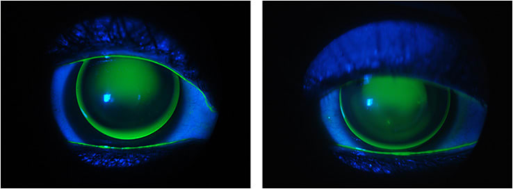 Figure 3. The new fit with a specialty keratoconus GP design.