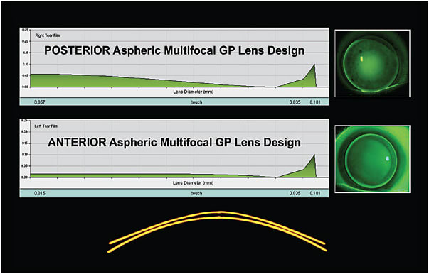 Figure 3. Front-aspheric multifocal GP designs have a spherical back surface, which prevents corneal steepening.