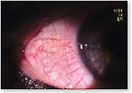 Figure 1. Tight lens syndrome caused by an early version of a hybrid lens. The lens had a very low Dk and tended to suction to the ocular surface.