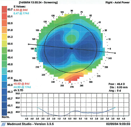 Figure 4. Anterior corneal topography of Patient #2 10 years after her transplant showing 3.7D of graft cylinder.