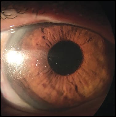 Figure 2. Poorly wetting scleral lens on a dry eye patient.