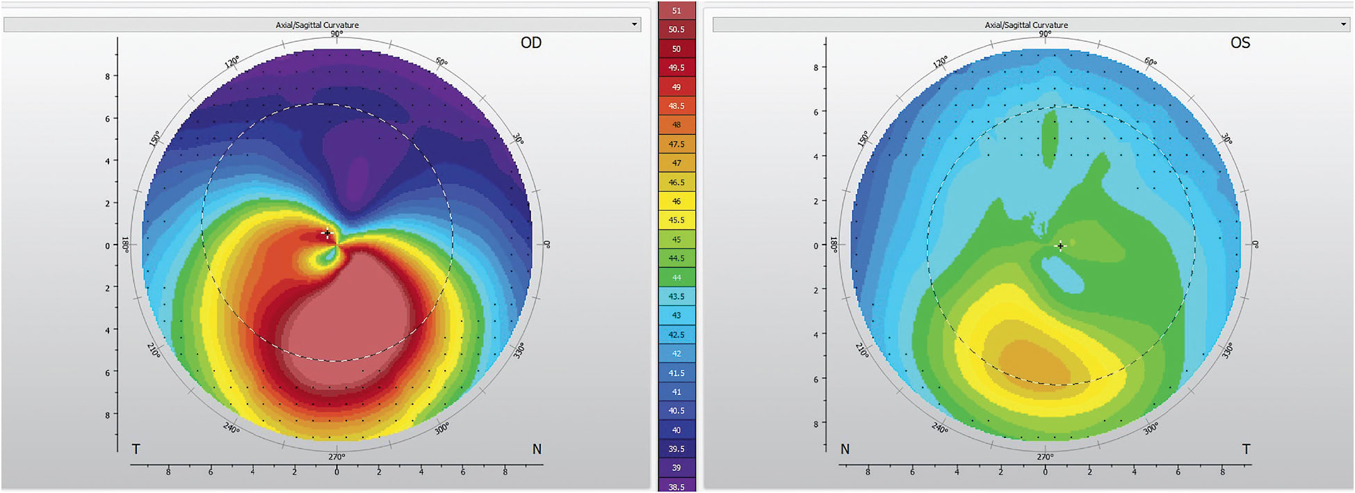 Figure 2. A topographical map of asymmetric irregular astigmatism, a common characteristic of keratoconus.