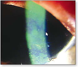 Figure 1. Anterior segment staining in a dry eye patient.