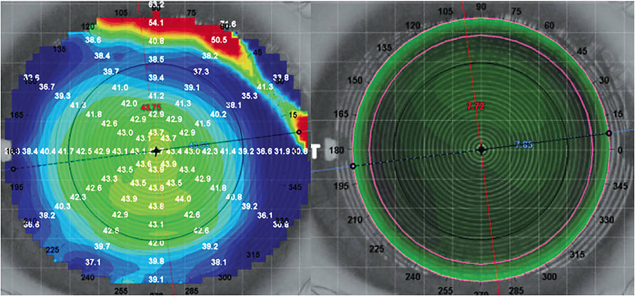 Figure 1. Topography is used for empirical lens fittings.