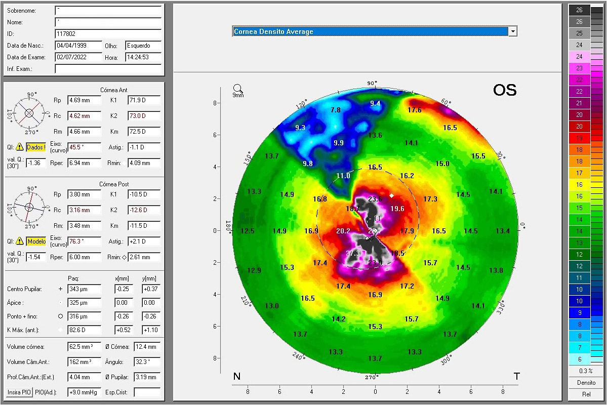 Figure 7. The corneal density average map from corneal tomography.