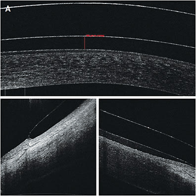 Figure 6. (A) OCT images of (top) central, (left) edge, and (right) limbal clearance.Image courtesy of Dr. Fayiz Mahgoub