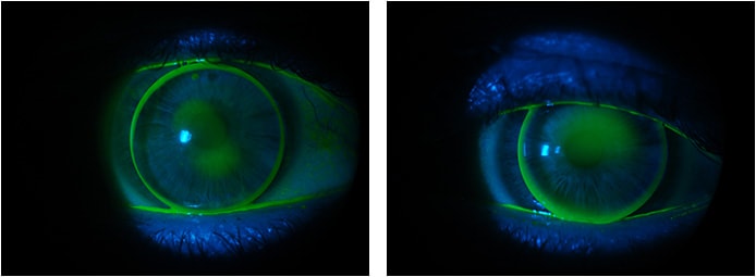 Figure 3. The new fluorescein pattern OD (left) and OS (right).