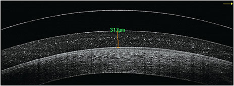 Figure 1. A patient wearing scleral lenses for severe keratoconjunctivitis sicca demonstrating marked post-lens tear fogging. There is a small level of scleral landing zone misalignment.