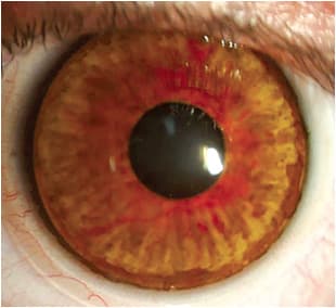 Figure 1. An opaque backing on a custom soft contact lens with a hand-painted iris ring that improves symptoms of photophobia and helps with cosmesis. 
Courtesy of Lefteris Karageorgiadis, BSc Optom.