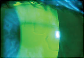 Figure 3. An example of a cornea with epithelial basement membrane dystrophy. The best-corrected visual acuity without the scleral lens is 20/50. With the scleral lens, the visual acuity is 20/20+.