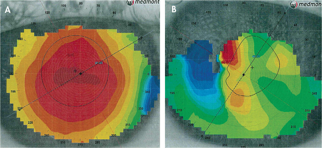 Figure 1. Corneal topography maps of our patient OD (A) and OS (B).