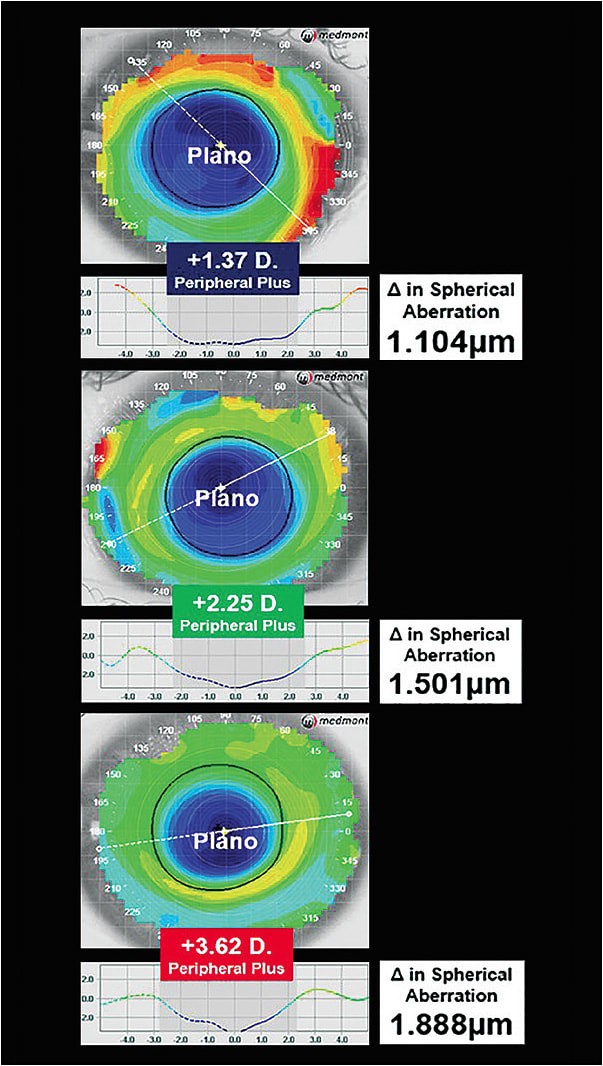 Figure 2. As the treatment zone diameter decreases, the peripheral plus within the 5.0mm chord increases.