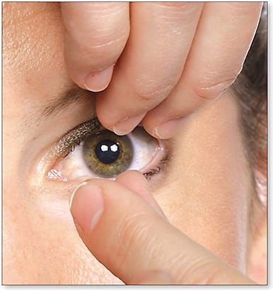 Figure 5. A technique to remove lenses coated with polyethylene glycol is the “duck lips” finger position. When the fingers start out touching and a pinch is applied to the inferior portion of the soft skirt, suction is broken and the lenses dislodge immediately. Conversely, if the user starts out with the fingers spread apart and tries to pinch the lens in the same position, it is much more difficult to remove the lens. Photo courtesy of SynergEyes