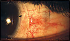 Figure 1. Keratoconus patient with impingement of a pinguecula with toric landing zone.