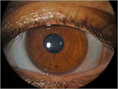 Figure 2. OS scleral lens and mild opacity at the apex, visual center.