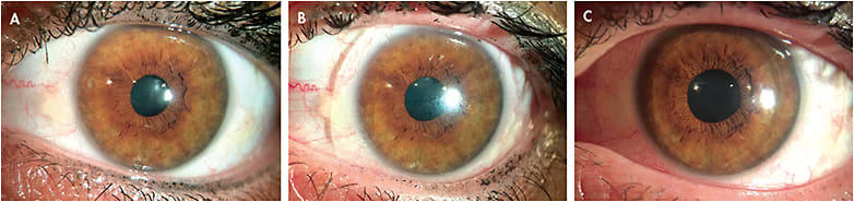 Figure 1. (A) A pinguecula nasally and temporally, adjacent to the limbus; (B) The pinguecula lifting off a small-diameter scleral lens; (C) A larger scleral lens was fitted with slight compression on the pinguecula.