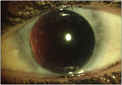 Figure 1. Our patient&amp;#8217;s left eye following multiple surgeries for iridocorneal endothelial syndrome (ICE).