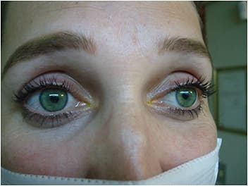 Figure 5. Patient wearing her corneal GPs, VA 20/15 J1 OD and OS with extended 30-day wear.