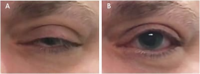 Figure 1. Improvement in ptosis with scleral lens wear.