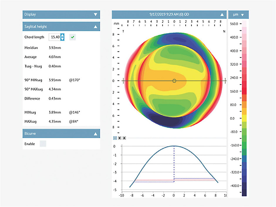 Figure 11. Profilometry of the right eye. The map shows a significant with-the-rule toric pattern. The data shows an average sagittal height of 4.07mm (4,070 microns). The difference value of 0.43mm indicates 430 microns of toricity.