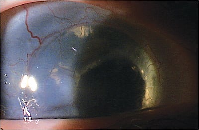 Figure 1. For this patient, for whom corneal topography could not be acquired, external videography was done and a still photo was extracted for consultation.