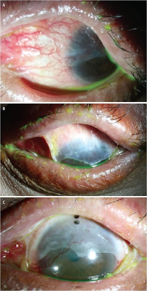 FIGURE 4. Images demonstrating conjunctivalization: progressive coverage of the cornea by conjunctival epithelium, leading to corneal opacification. Photos courtesy of Gloria Chiu, OD.