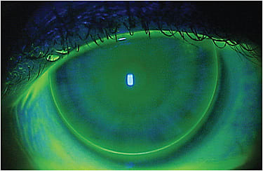 Figure 2. Initial fluorescein pattern of post-LASIK orthokeratology for the Case 2 patient.