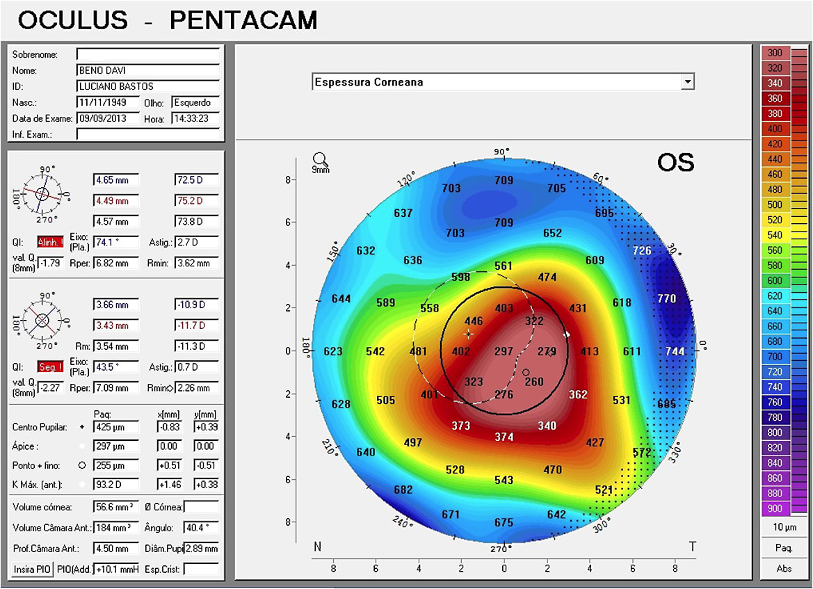 Figure 4. Corneal thickness map OS.