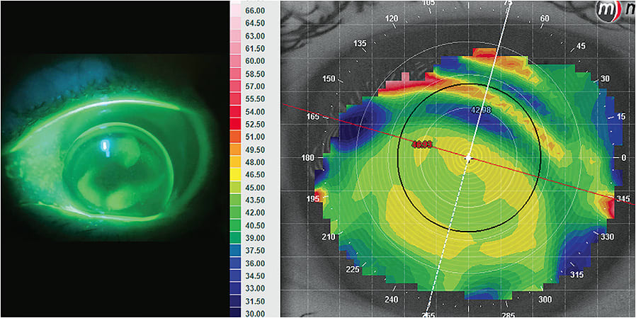 Figure 1. Corneal warpage resulting from an inferiorly decentering GP lens.
