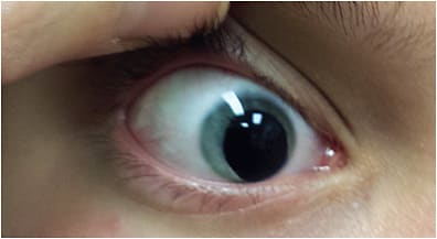 Figure 1. Traumatic aphakia, mydriasis, and corneal scarring in this 7-year-old patient indicates a need for a specialty contact lens.