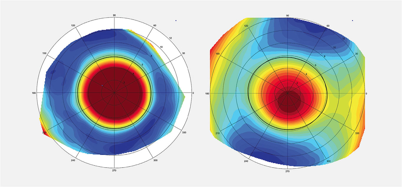 Figure 3. Scleral topographical maps. The image on the left reveals a sclera with little toricity. The image on the right reveals a sclera with a large difference in elevation in opposite meridians. This difference in elevations would benefit from a toric haptic when fitting a scleral contact lens. Images courtesy of Greg DeNaeyer, OD