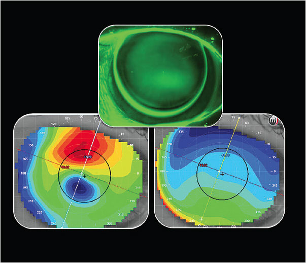 Figure 2. Topographical displays and fluorescein pattern.