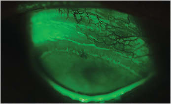 Figure 9. Furrow staining (pooling of fluorescein-saturated tears) and limbal epithelial hypertrophy immediately after lens removal.&#xD;&#xA;Image courtesy of Steve Byrnes, OD.