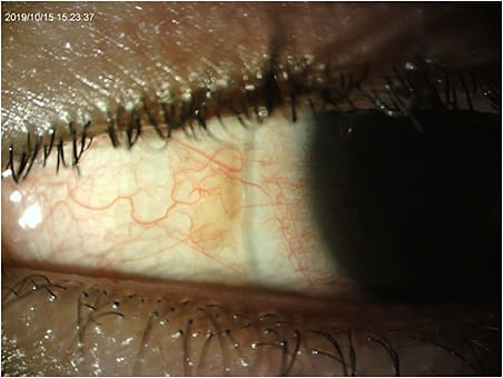 Figure 1. Nasal blanching and impingement with habitual scleral lens OS