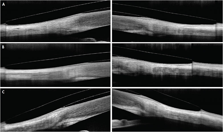 Figure 2. Conjunctival compression beneath a scleral lens observed with OCT imaging after (A) five minutes, (B) two hours, and (C) eight hours of wear.