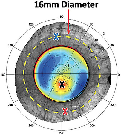 Figure 1. Sagittal height values were measured 180º apart along the meridian that bisects the geometric center and corneal apex.