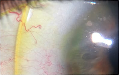 Figure 5. Fluorescein pooling beneath a lifted edge, observed at the slit lamp with a white light.