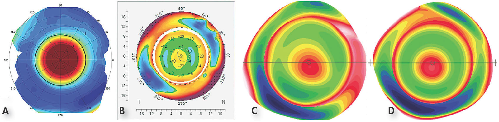 Figure 4. Scleral shape patterns: (A) spherical sclera, little difference in slope 360º around; (B) regularly toric, the meridian at 130º is elevated and therefore flatter in curvature, while the meridian at 40º has increased sag and therefore is steeper in curvature; (C) asymmetric toric, the meridian at 80º is steeper, but much more so in the inferior quadrant than in the superior quadrant, while the quadrant on the right is much higher compared with the quadrant on the left; (D) asymmetric, the flattest part of the sclera at 110º is opposed to a very steep aspect of the sclera inferiorly.