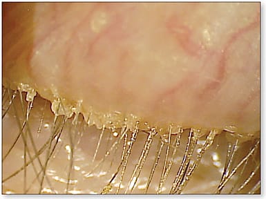 Figure 1. Significant blepharitis.