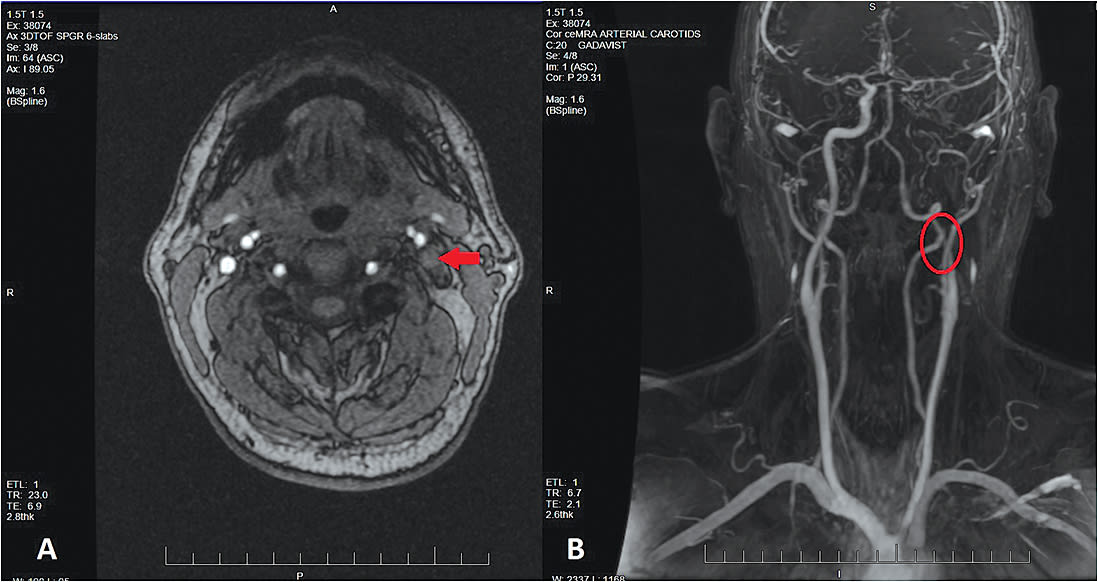 Figure 1. (A) Axial 3D time-of-flight MRA image of the head demonstrates a left internal carotid artery dissection with complete occlusion (arrow). (B) Contrast-enhanced MRA coronal image showing the extent of occlusion beginning at the cervical (C1) level of the left internal carotid artery (circle).