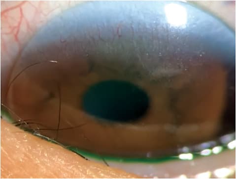 Figure 3. Evaluation of the add zone during downgaze. Not enough translation was observed in this case. The patient complained of fluctuating vision at near. The lens edge was flattened to allow increased translation on downgaze.